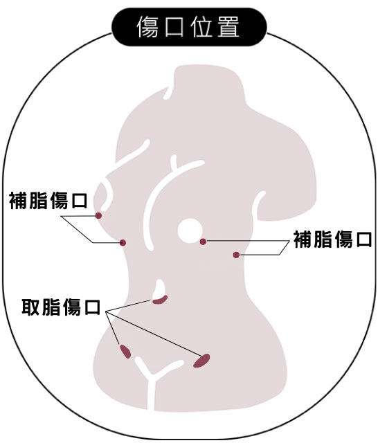 自體脂肪隆乳抽脂位置